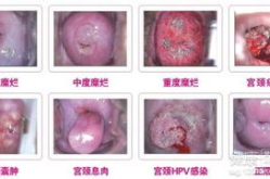 宫颈糜烂的早期症状,识别与预防的关键”